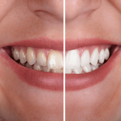 clareamneto_dental-min